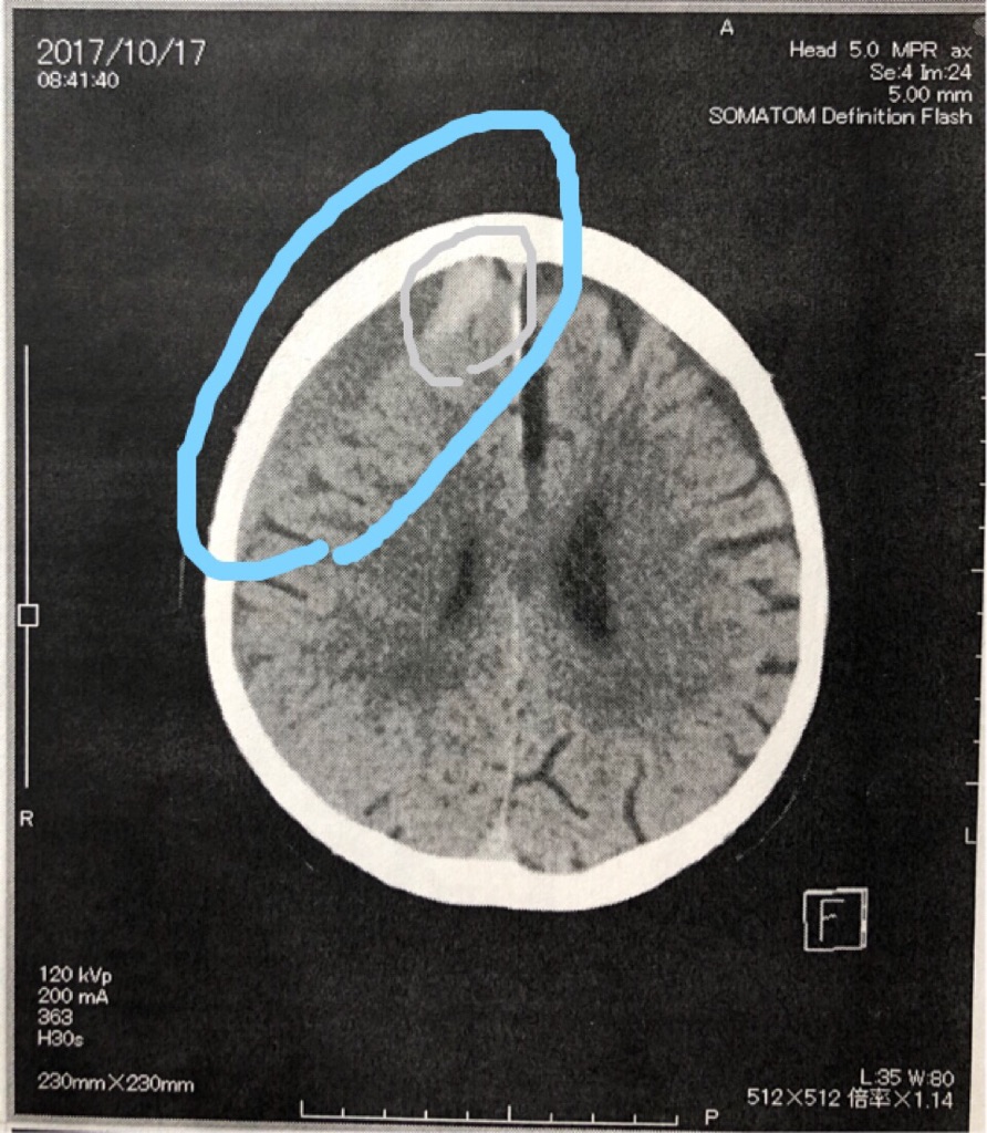 慢性硬膜下血腫CT画像